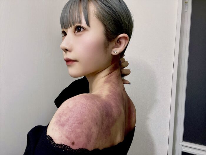 Former AV actress Yui Shirasaka (23) shows her back covered in bruises with a painful slimming esthetic called cellulite crush 3th image